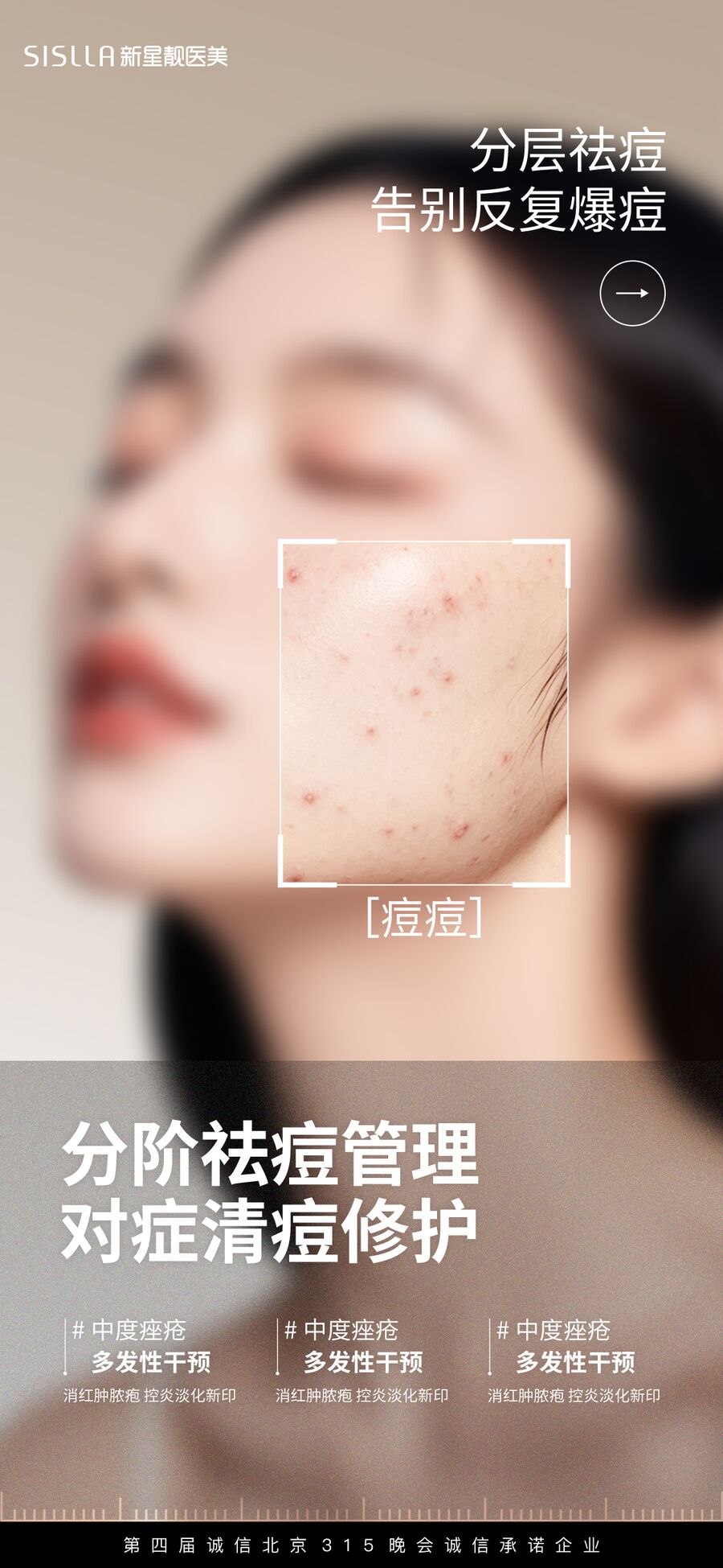 分阶祛痘管理